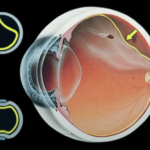 老年,致盲,疾病,白内障,青光眼,糖尿病视网膜病变,老年性黄斑变性